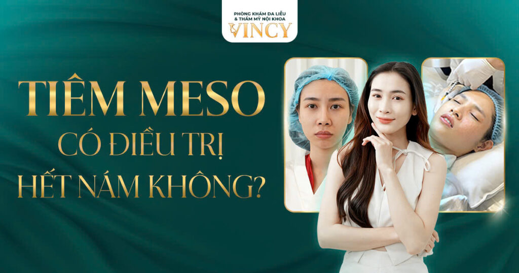 TIÊM MESO CÓ ĐIỀU TRỊ HẾT NÁM KHÔNG?
