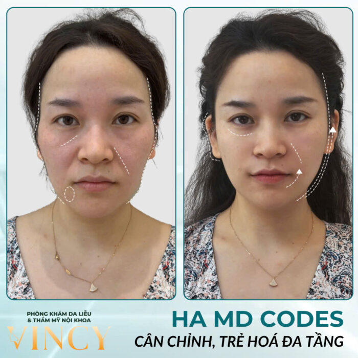 HA MD CODES - PHƯƠNG PHÁP ĐỈNH CAO TRẺ HÓA ĐA TẦNG 5 Cơ Chế Nâng Đỡ Sức Kéo Cho Cơ.