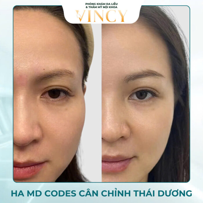 HA MD CODES - PHƯƠNG PHÁP ĐỈNH CAO TRẺ HÓA ĐA TẦNG 7 Phù hợp với những người bận rộn, không có nhiều thời gian để nghỉ ngơi sau các thủ thuật thẩm mỹ.