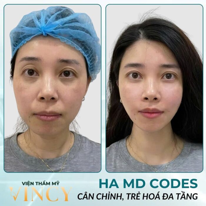 HA MD CODES - PHƯƠNG PHÁP ĐỈNH CAO TRẺ HÓA ĐA TẦNG 6 Trẻ hóa đa tầng HA MD Codes đã trở thành lựa chọn hàng đầu của nhiều người trong việc duy trì và cải thiện vẻ đẹp tự nhiên của khuôn mặt.